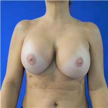 Breast Implant Revision Before Photo by Steven Camp, MD; Fort Worth, TX - Case 47147