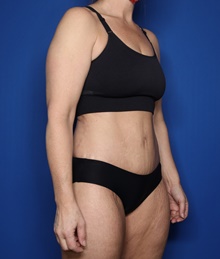 Tummy Tuck After Photo by Steven Camp, MD; Fort Worth, TX - Case 47149