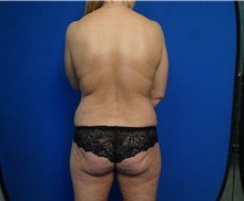 Tummy Tuck Before Photo by Steven Camp, MD; Fort Worth, TX - Case 47149