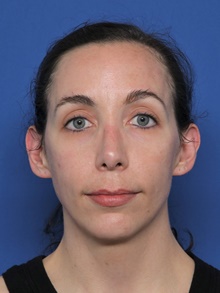 Rhinoplasty After Photo by Steven Camp, MD; Fort Worth, TX - Case 47150