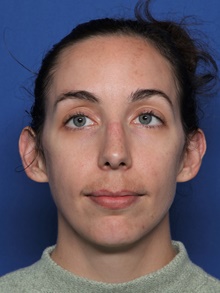 Rhinoplasty Before Photo by Steven Camp, MD; Fort Worth, TX - Case 47150