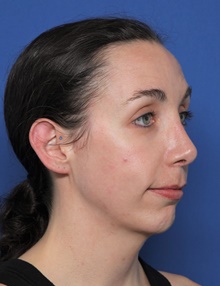 Rhinoplasty After Photo by Steven Camp, MD; Fort Worth, TX - Case 47150