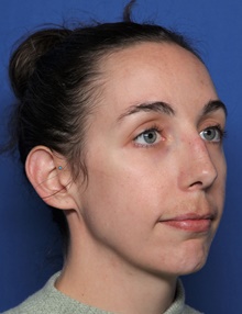 Rhinoplasty Before Photo by Steven Camp, MD; Fort Worth, TX - Case 47150