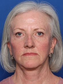 Facelift After Photo by Steven Camp, MD; Fort Worth, TX - Case 47156