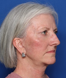 Facelift After Photo by Steven Camp, MD; Fort Worth, TX - Case 47156