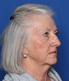 Facelift Before Photo by Steven Camp, MD; Fort Worth, TX - Case 47156