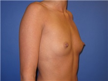 Breast Augmentation Before Photo by Austin Hayes, MD; Portland, OR - Case 29772