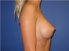 Breast Augmentation After Photo by Austin Hayes, MD; Portland, OR - Case 29772