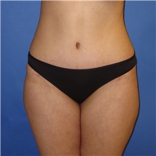 Tummy Tuck After Photo by Austin Hayes, MD; Portland, OR - Case 31141