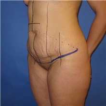 Tummy Tuck Before Photo by Austin Hayes, MD; Portland, OR - Case 31141