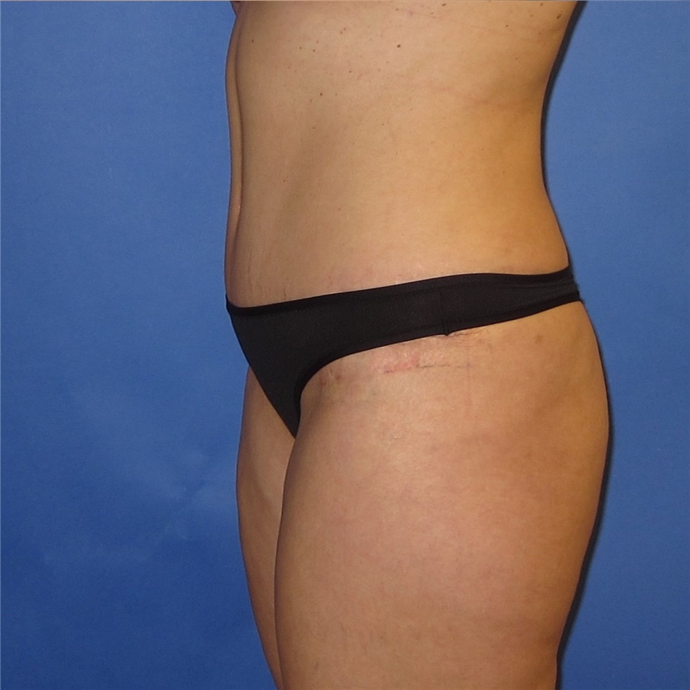 Tummy Tuck Before and After Photos - Portland Plastic Surgery