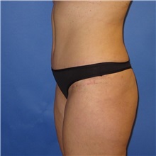 Tummy Tuck After Photo by Austin Hayes, MD; Portland, OR - Case 31141