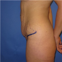 Tummy Tuck Before Photo by Austin Hayes, MD; Portland, OR - Case 31141