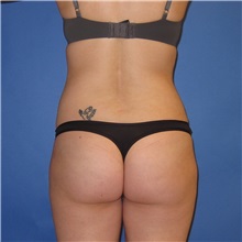 Buttock Lift with Augmentation Before and After Photos