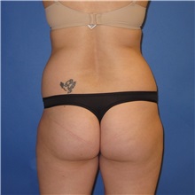 Buttock Lift with Augmentation Before Photo by Austin Hayes, MD; Portland, OR - Case 31142