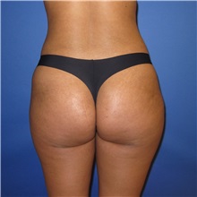 Buttock Lift with Augmentation After Photo by Austin Hayes, MD; Portland, OR - Case 31143