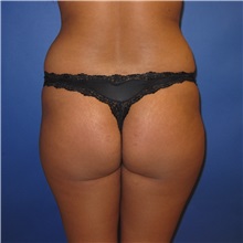 Buttock Lift with Augmentation Before Photo by Austin Hayes, MD; Portland, OR - Case 31143