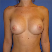 Breast Augmentation After Photo by Austin Hayes, MD; Portland, OR - Case 31144