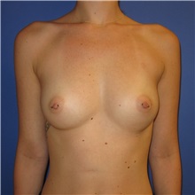 Breast Augmentation Before Photo by Austin Hayes, MD; Portland, OR - Case 31144