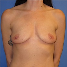 Breast Implant Removal After Photo by Austin Hayes, MD; Portland, OR - Case 31145