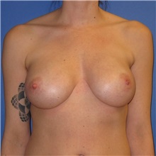 Breast Implant Removal Before Photo by Austin Hayes, MD; Portland, OR - Case 31145