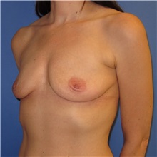 Breast Implant Removal After Photo by Austin Hayes, MD; Portland, OR - Case 31145