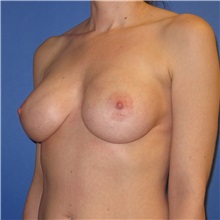 Breast Implant Removal Before Photo by Austin Hayes, MD; Portland, OR - Case 31145