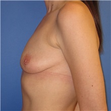 Breast Implant Removal After Photo by Austin Hayes, MD; Portland, OR - Case 31145