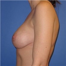 Breast Implant Removal Before Photo by Austin Hayes, MD; Portland, OR - Case 31145