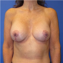 Breast Lift After Photo by Austin Hayes, MD; Portland, OR - Case 31146