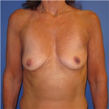 Breast Lift Before Photo by Austin Hayes, MD; Portland, OR - Case 31146