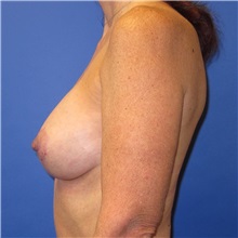 Breast Lift After Photo by Austin Hayes, MD; Portland, OR - Case 31146