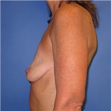 Breast Lift Before Photo by Austin Hayes, MD; Portland, OR - Case 31146