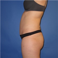 Tummy Tuck After Photo by Austin Hayes, MD; Portland, OR - Case 32100