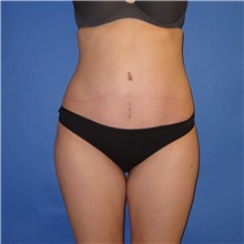 Tummy Tuck After Photo by Austin Hayes, MD; Portland, OR - Case 32100