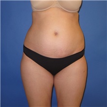 Tummy Tuck Before Photo by Austin Hayes, MD; Portland, OR - Case 32100