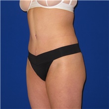 Tummy Tuck After Photo by Austin Hayes, MD; Portland, OR - Case 38730