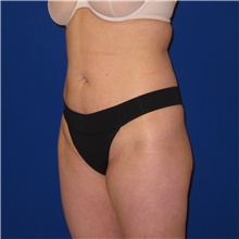 Tummy Tuck Before Photo by Austin Hayes, MD; Portland, OR - Case 38730