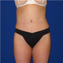 Tummy Tuck After Photo by Austin Hayes, MD; Portland, OR - Case 38730