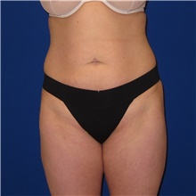 Tummy Tuck Before Photo by Austin Hayes, MD; Portland, OR - Case 38730