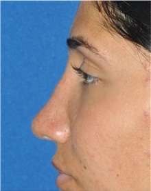 Rhinoplasty After Photo by Ali Totonchi, MD; Lyndhurst, OH - Case 45543