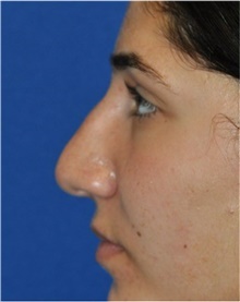 Rhinoplasty Before Photo by Ali Totonchi, MD; Lyndhurst, OH - Case 45543