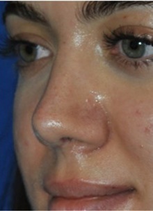 Rhinoplasty After Photo by Ali Totonchi, MD; Lyndhurst, OH - Case 45544