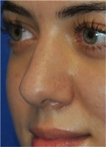 Rhinoplasty Before Photo by Ali Totonchi, MD; Lyndhurst, OH - Case 45544
