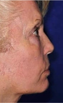 Neck Lift After Photo by Ali Totonchi, MD; Cleveland, OH - Case 45570
