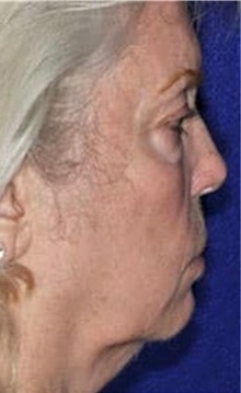 Neck Lift Before Photo by Ali Totonchi, MD; Cleveland, OH - Case 45570