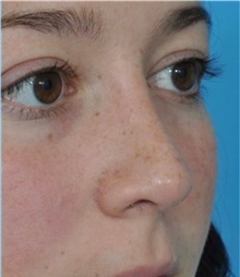Rhinoplasty After Photo by Ali Totonchi, MD; Lyndhurst, OH - Case 45571