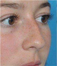 Rhinoplasty Before Photo by Ali Totonchi, MD; Lyndhurst, OH - Case 45571
