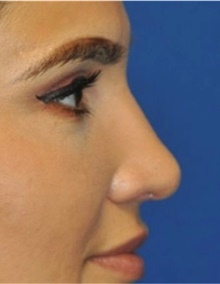 Rhinoplasty After Photo by Ali Totonchi, MD; Cleveland, OH - Case 45572