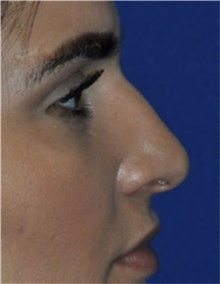 Rhinoplasty Before Photo by Ali Totonchi, MD; Cleveland, OH - Case 45572